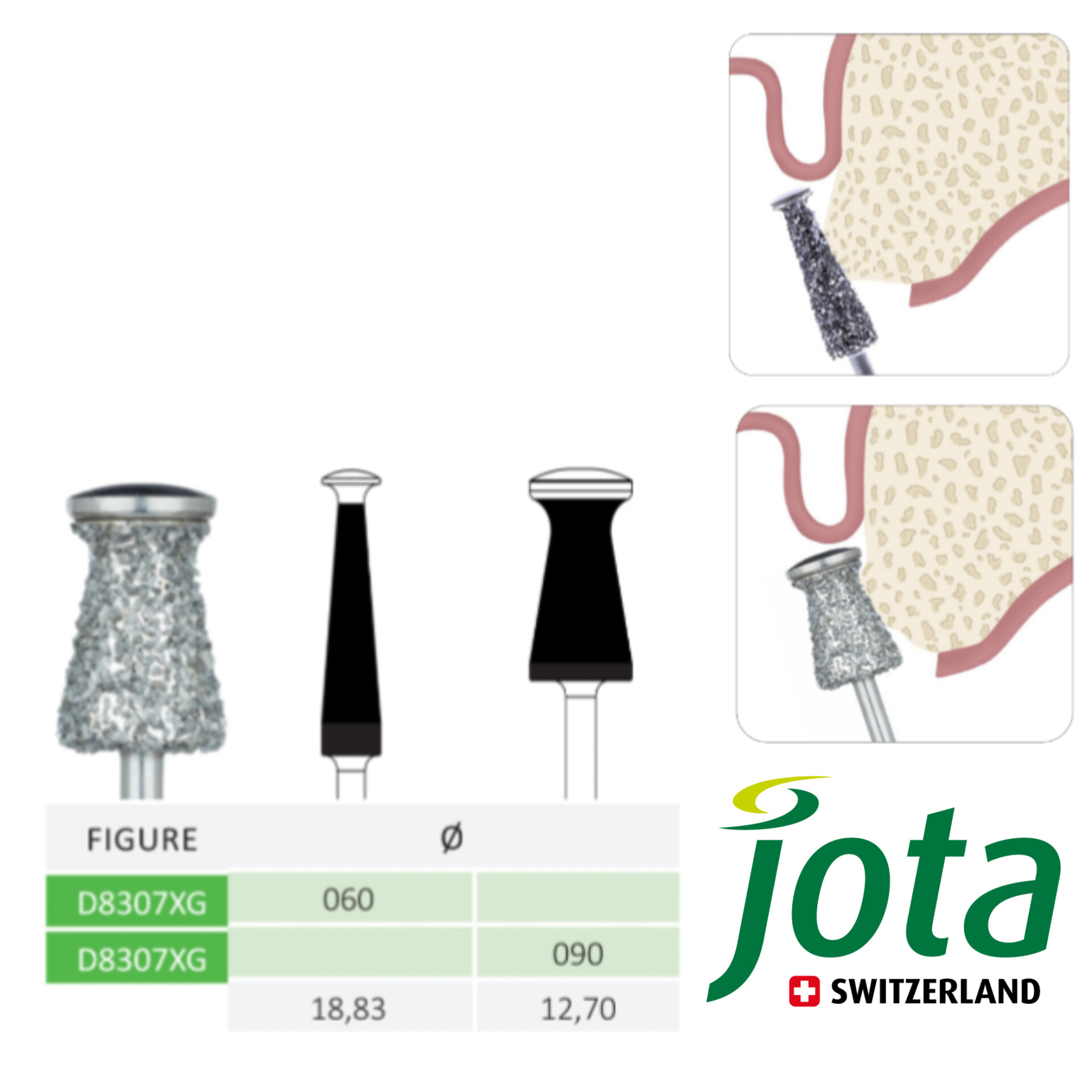 فرز جراحی الماسی آلو‌ئوپلاستی برای کانتورینگ ریج جوتا JOTA کد D8307XG